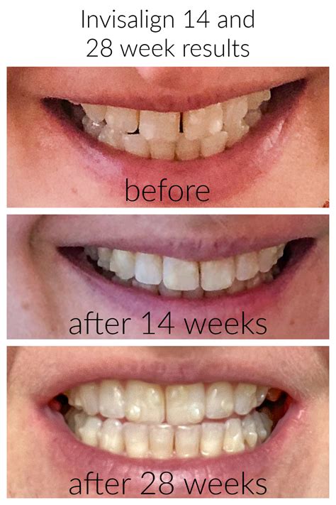 how long to see invisalign results